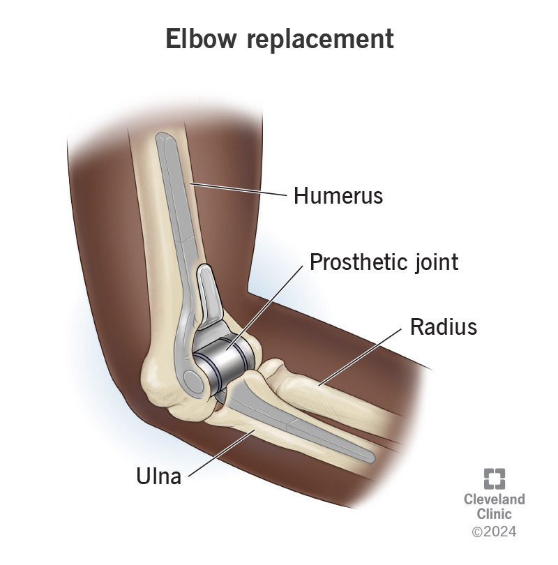 Elbow Replacement