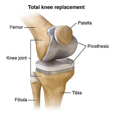 Knee Replacement