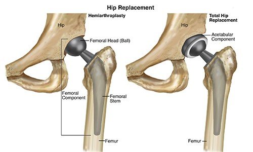 Knee Replacement